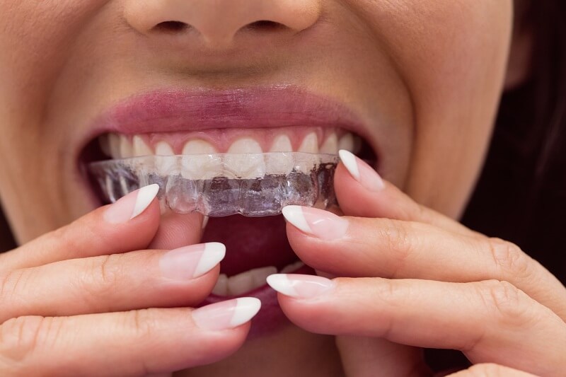 invisalign braces for teeth