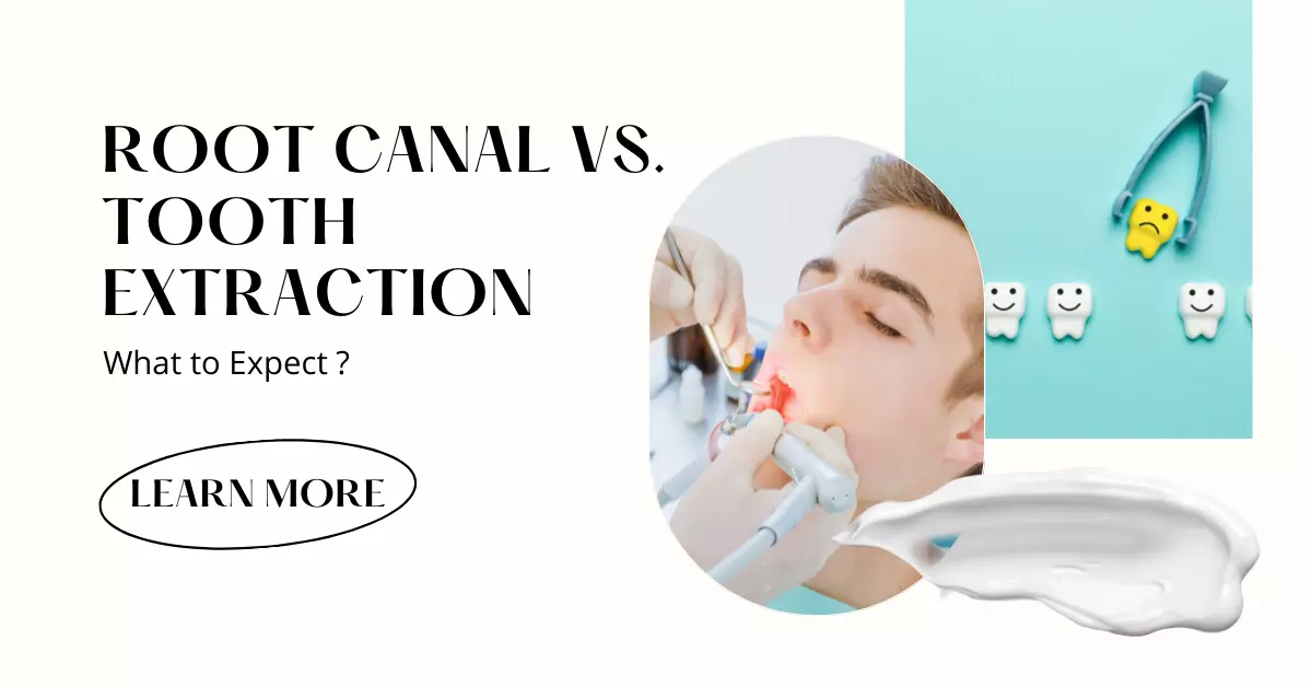 Root Canal vs. Tooth Extraction
