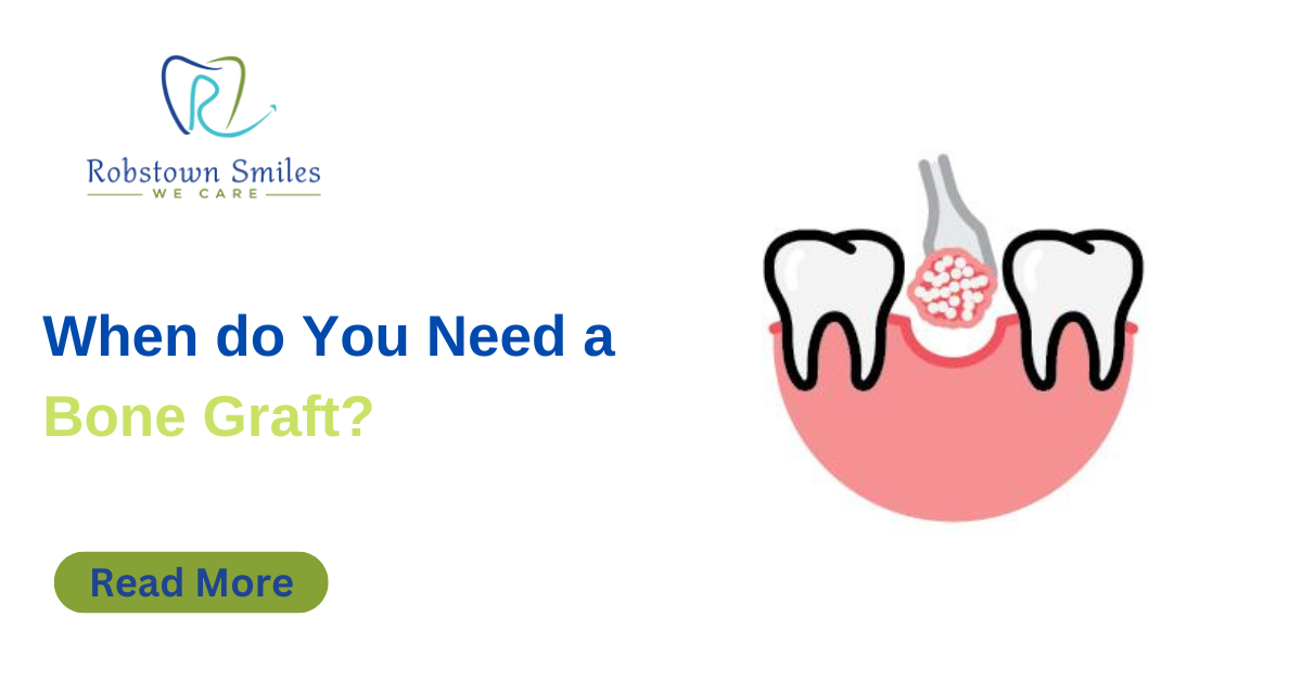 When do You Need a Bone Graft?