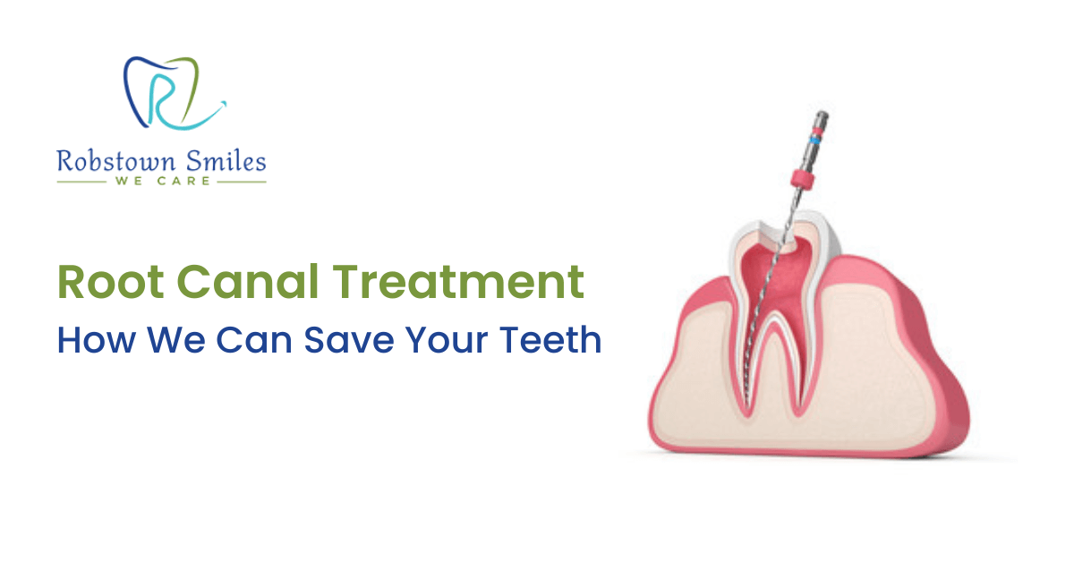 Root Canal Treatment – How We Can Save Your Teeth
