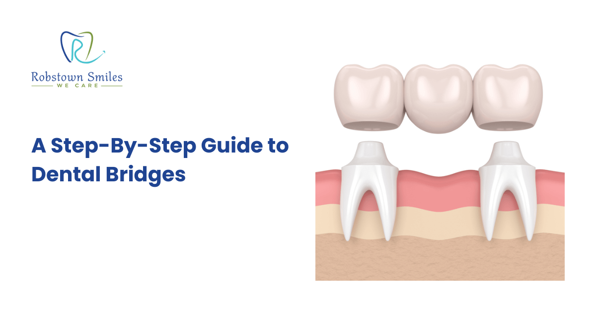 A Step-By-Step Guide to Dental Bridges