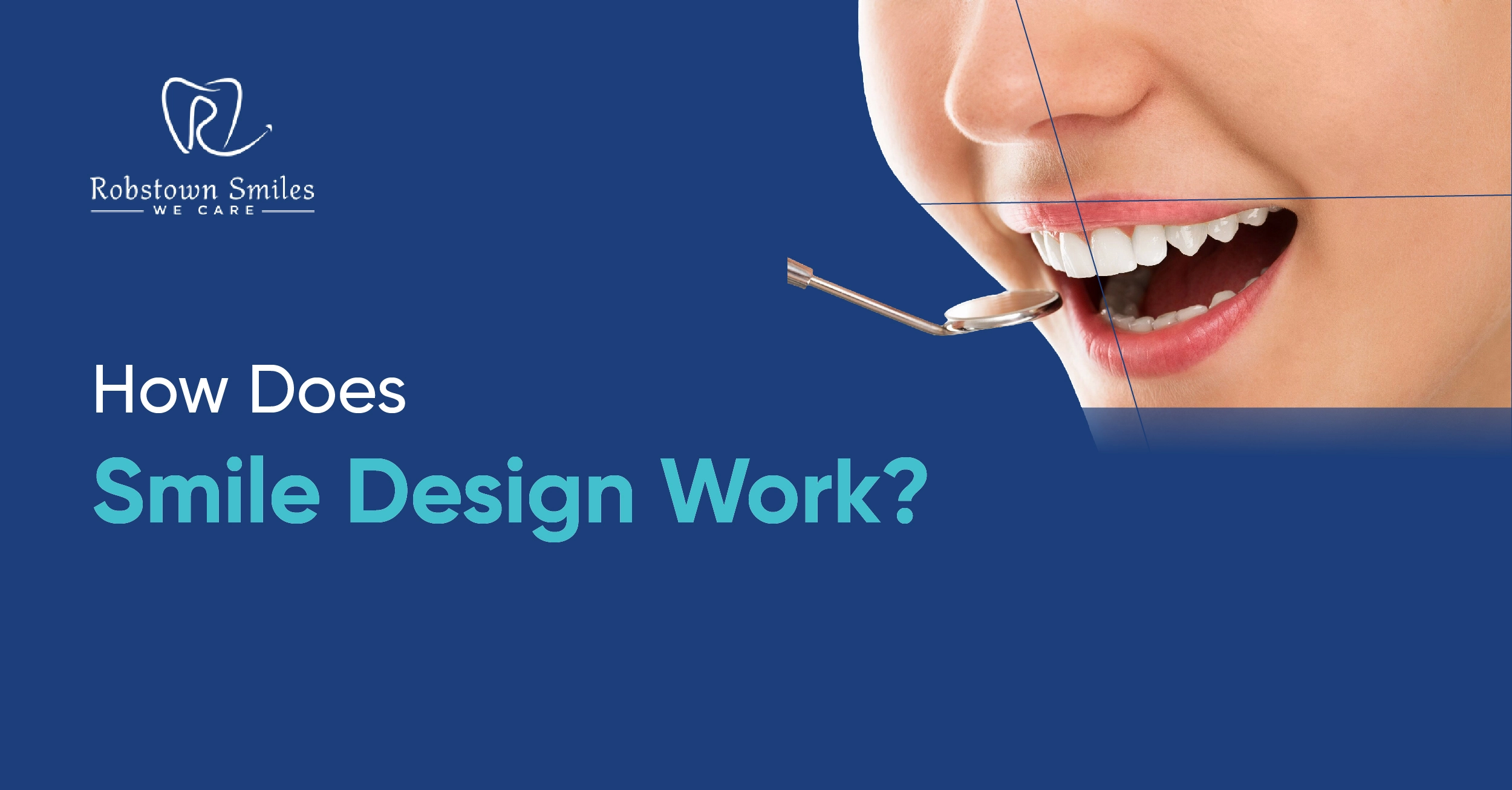 How Does Smile Design Work?