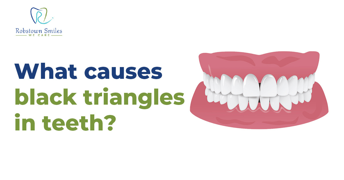 What Causes Black Triangles in Teeth?